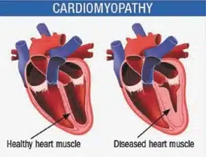 cardiomyopathy